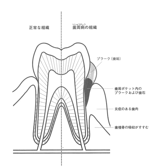 歯周病の原因