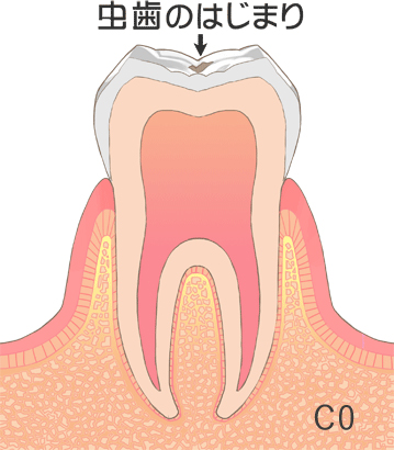 虫歯の治療