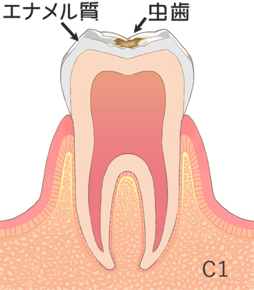 虫歯の治療