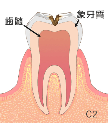 虫歯の治療