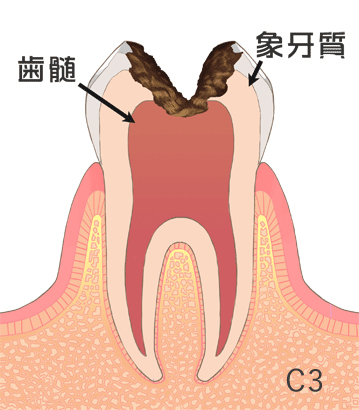 虫歯の治療