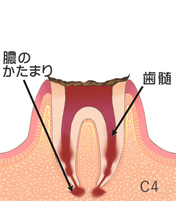 虫歯の治療