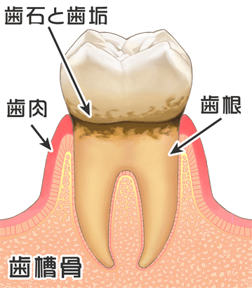 歯周病の治療