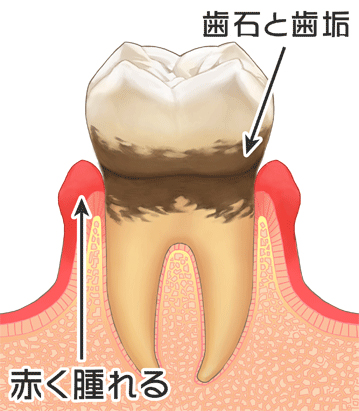 歯周病の治療