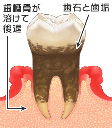 歯周病の治療